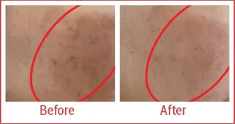 RF Microneedling in Pakistan – Benefits, Cost & Side Effects